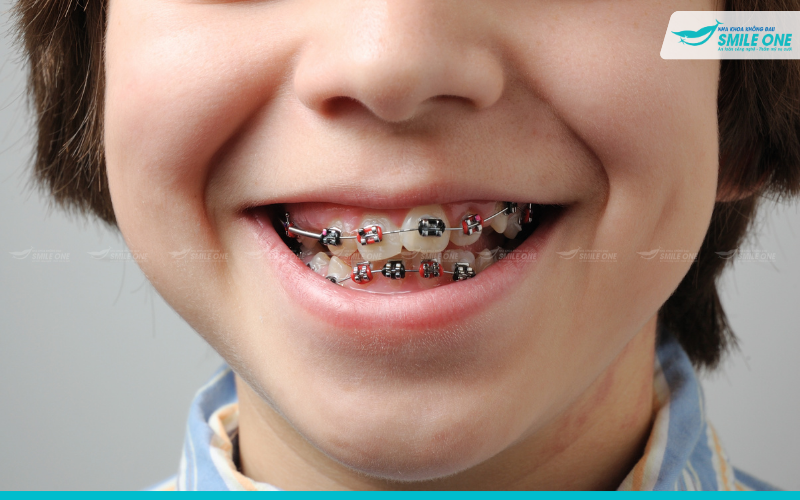 Khi nào cần niềng răng – Thời điểm nào niềng răng tốt nhất 3