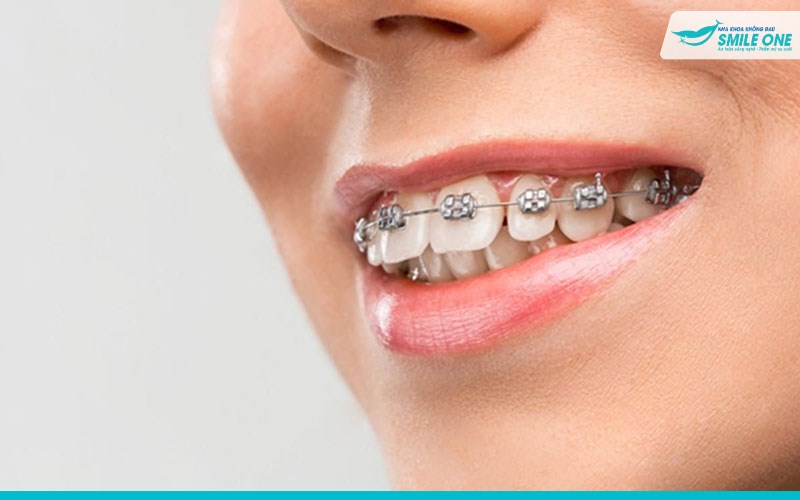 Khi nào cần niềng răng – Thời điểm nào niềng răng tốt nhất? 2